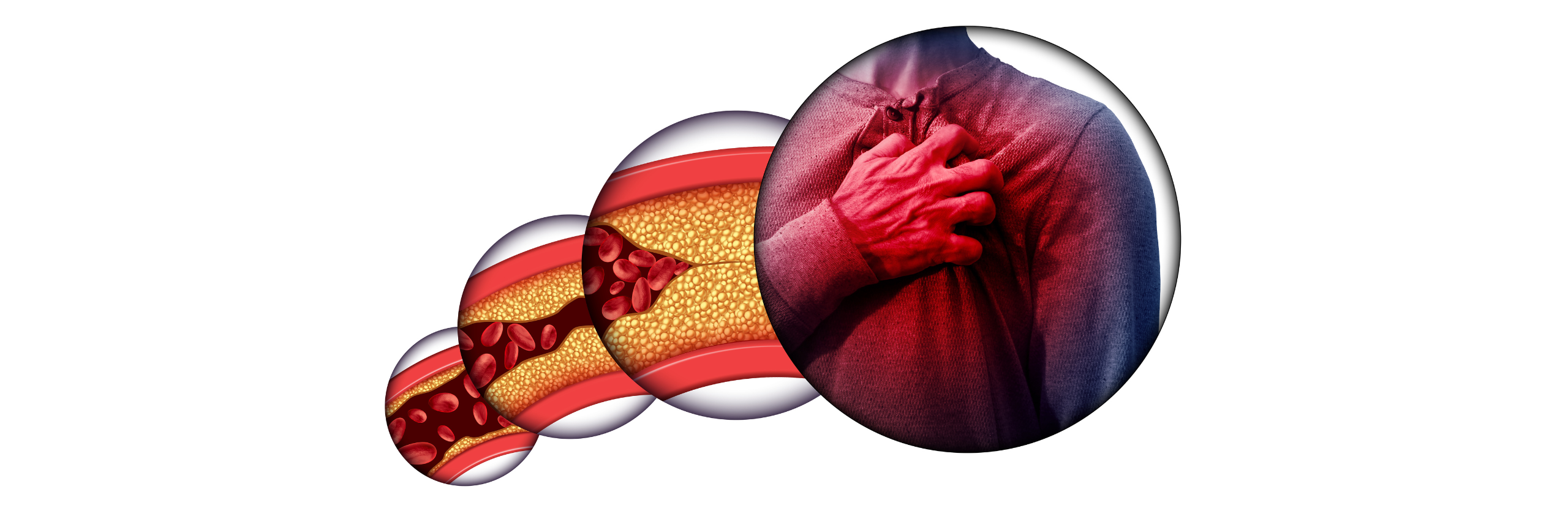 Cardiopatía Isquémica 3-4