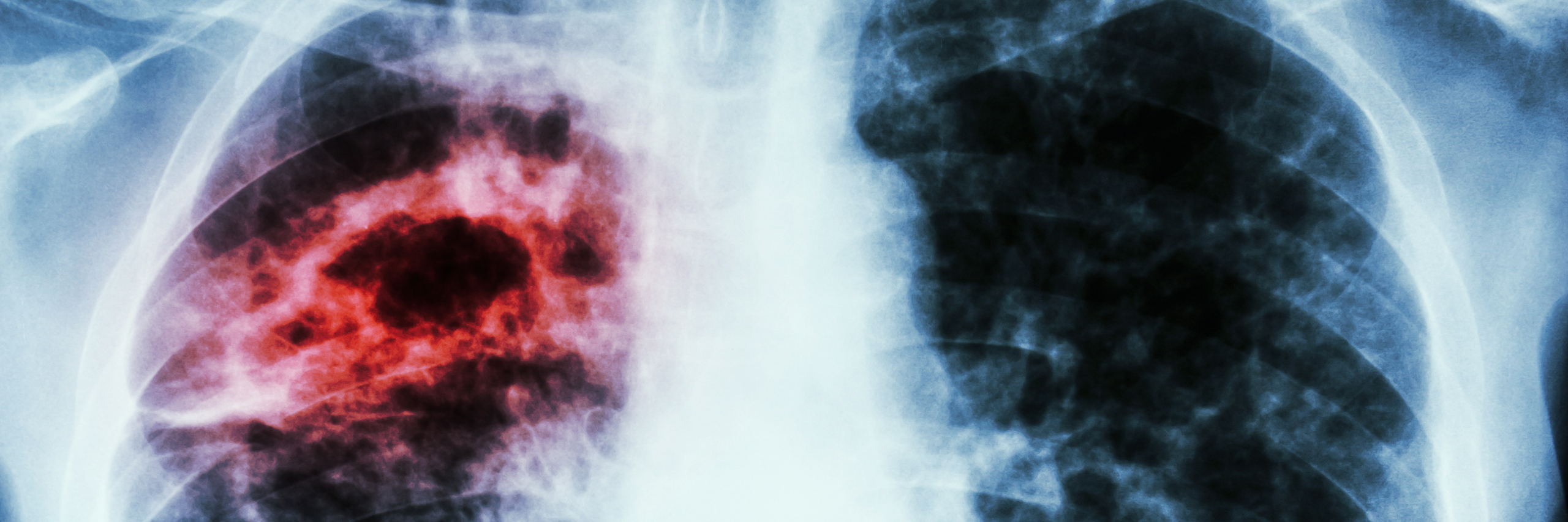 Tromboembolismo Pulmonar 1